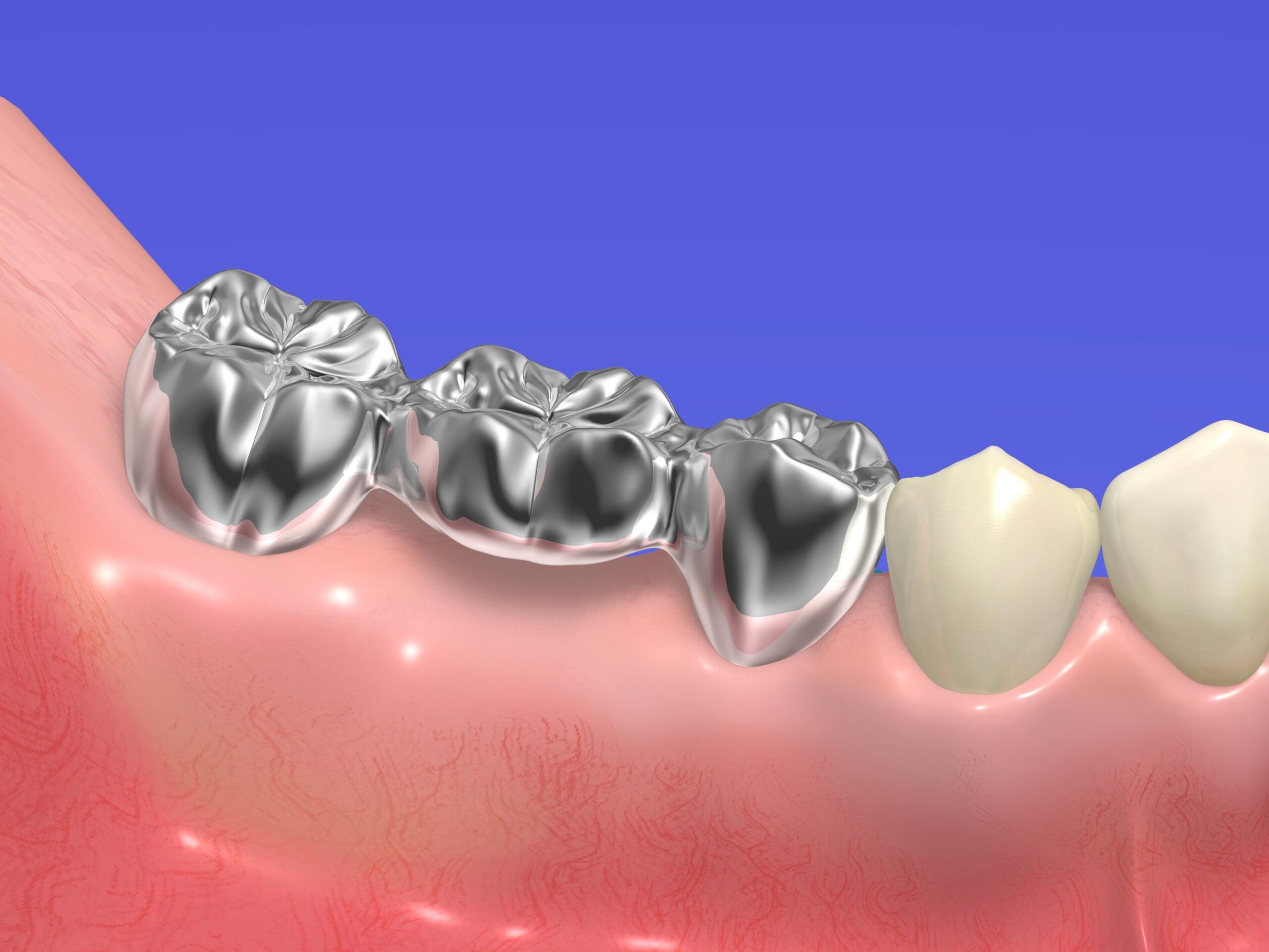 silver tooth dental treatment