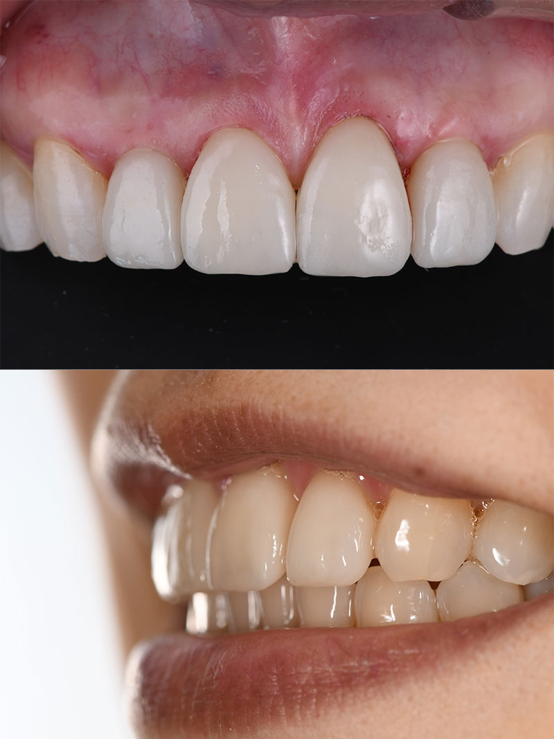 ラミネートベニア 治療後