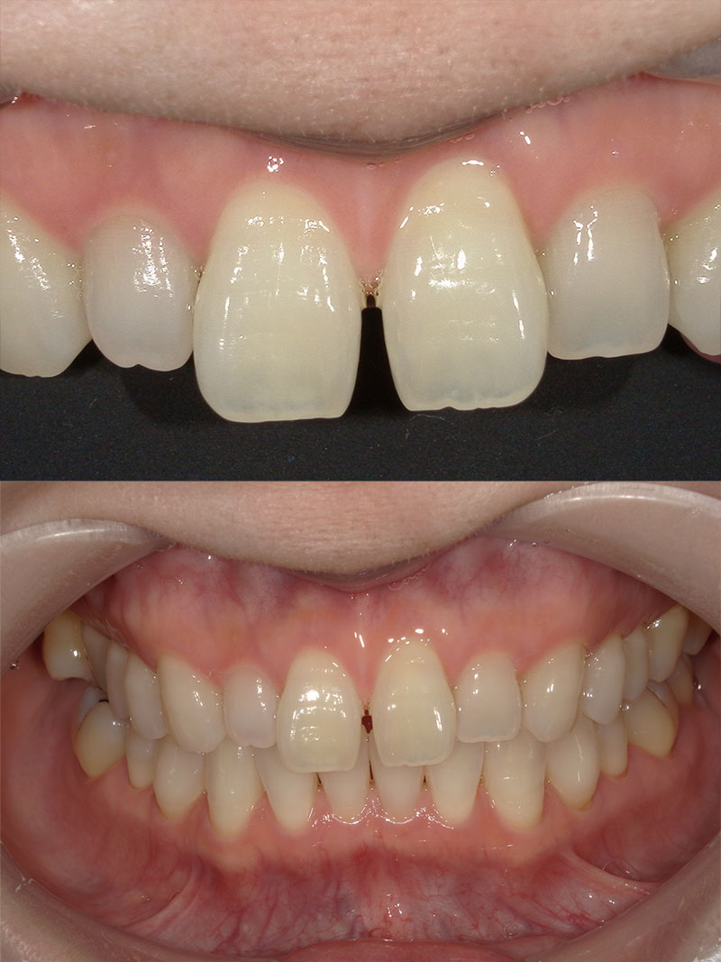 ラミネートベニア 治療前
