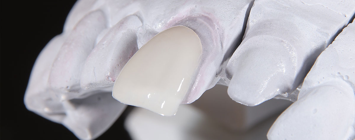 京橋歯科医院　ラミネートベニアとは？