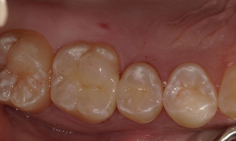 セラミックインレー 治療後