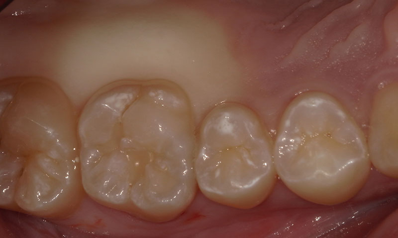セラミックインレー 治療前
