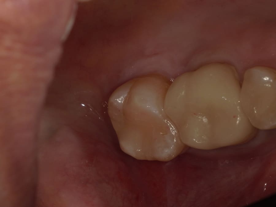 セラミックインレー（焼成セラミック） 治療前