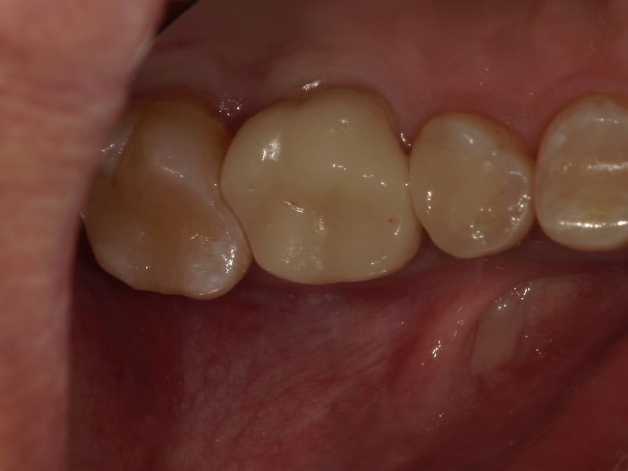 セラミックインレー（焼成セラミック） 治療後